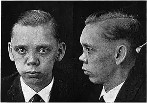 Saddle nose (heredosyphilis)