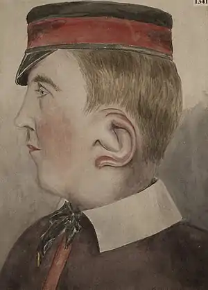 Hypertrophy of the ear (macrotia)