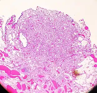 An adenomatoid tumor of the fallopian tube, low magnification, displaying infiltrative-like borders.