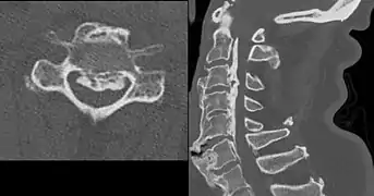 Ossification of the posterior longitudinal ligament in DISH